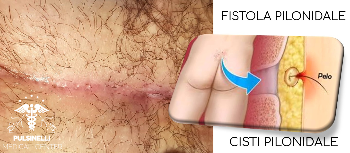 cisti pilonidale laser alessandrite pulsinelli 02