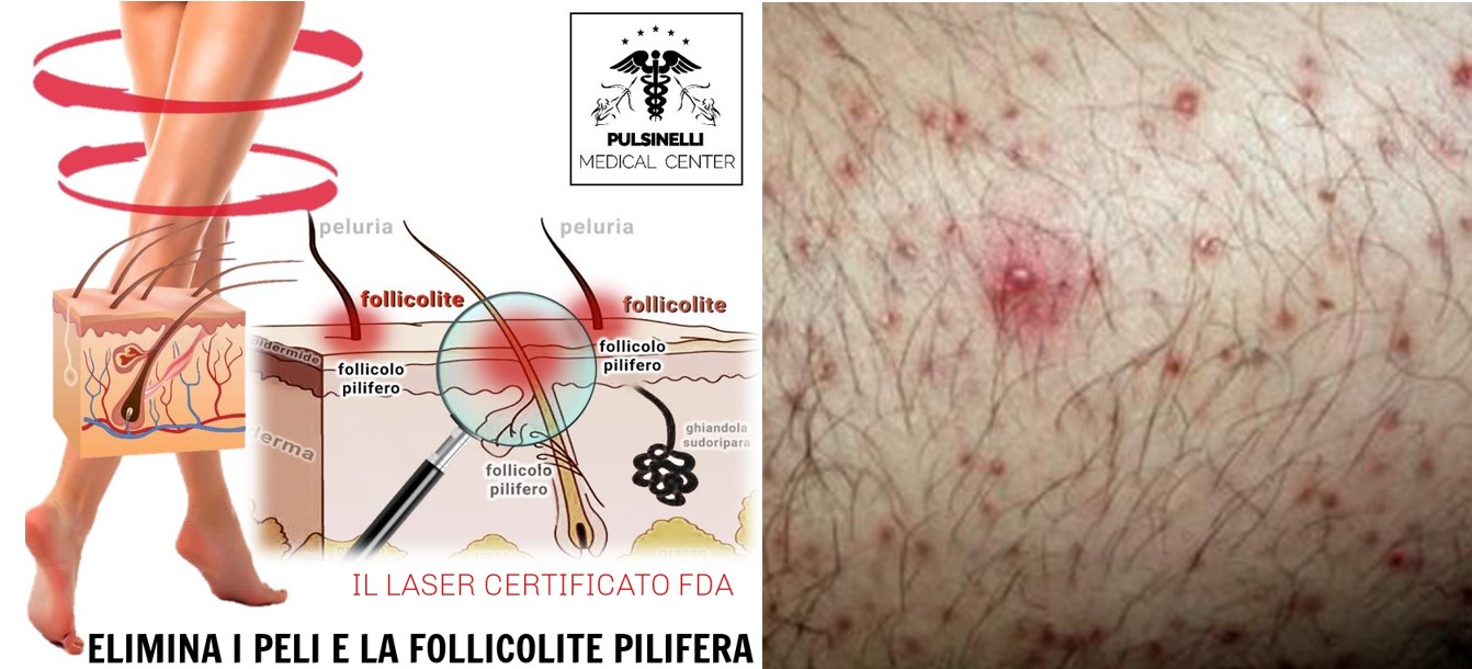 follicolite pilifera pulsinelli medical center 01