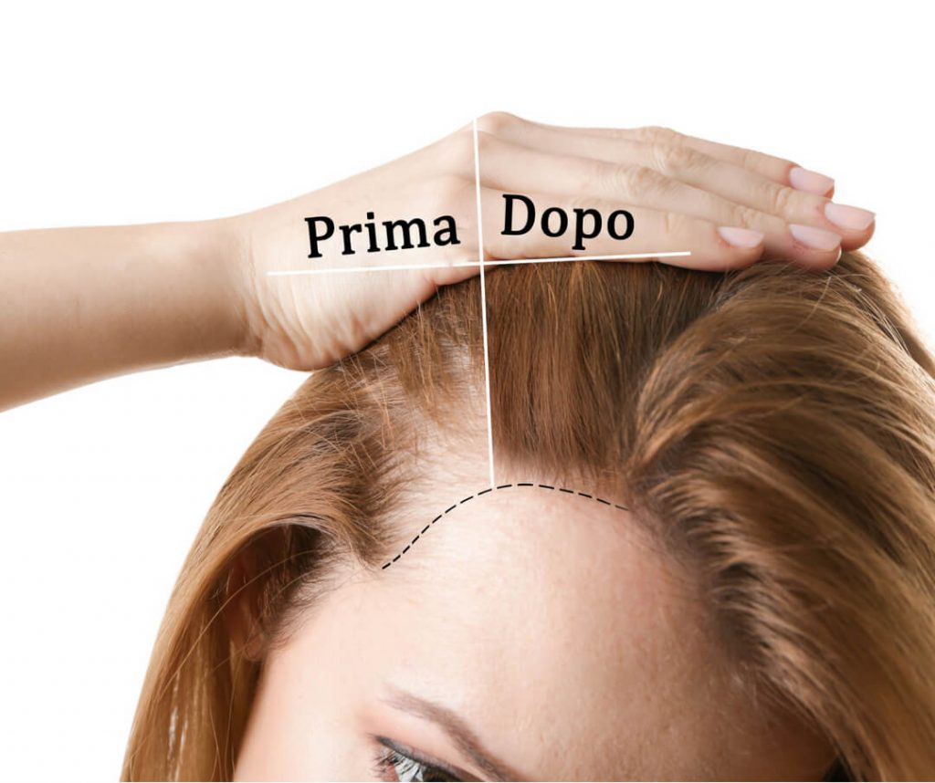carbossiterapia-capelli-pulsinelli medical center