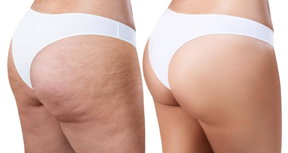 cellulite carbossiterapia