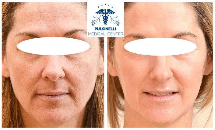 FRAXEL LASER PULSINELLI MEDICAL CENTER