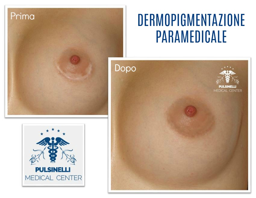 DERMOPIGMENTAZIONE PARAMEDICALE