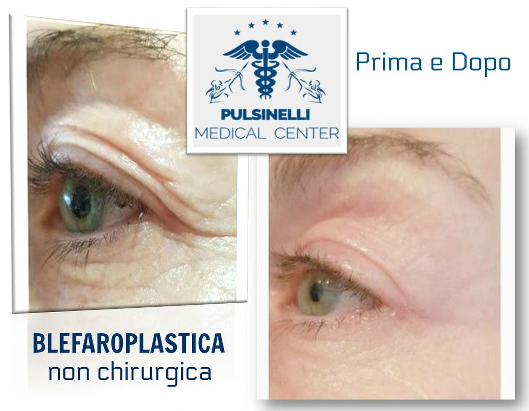 blefaroplastica-non-chirurgica-latina-1_2000x1554