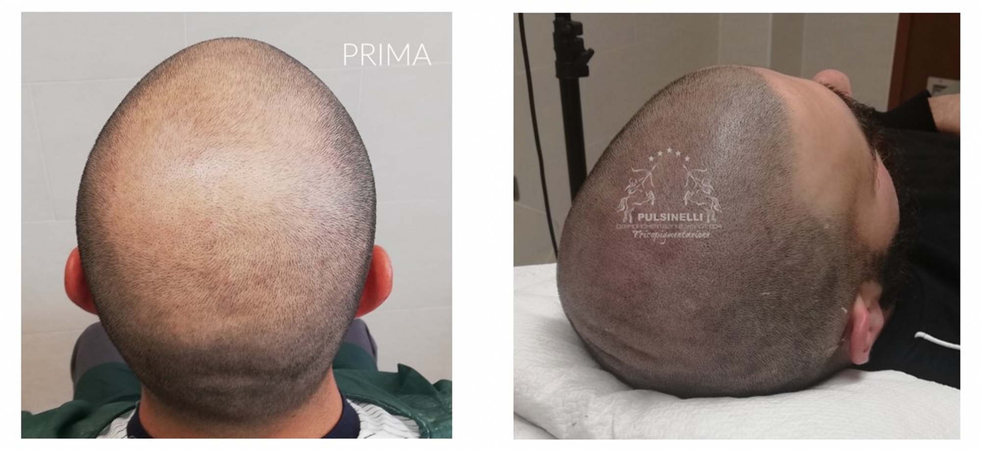 TRICOPIGMENTAZIONE PER ALOPECIA  O CALVIZIE