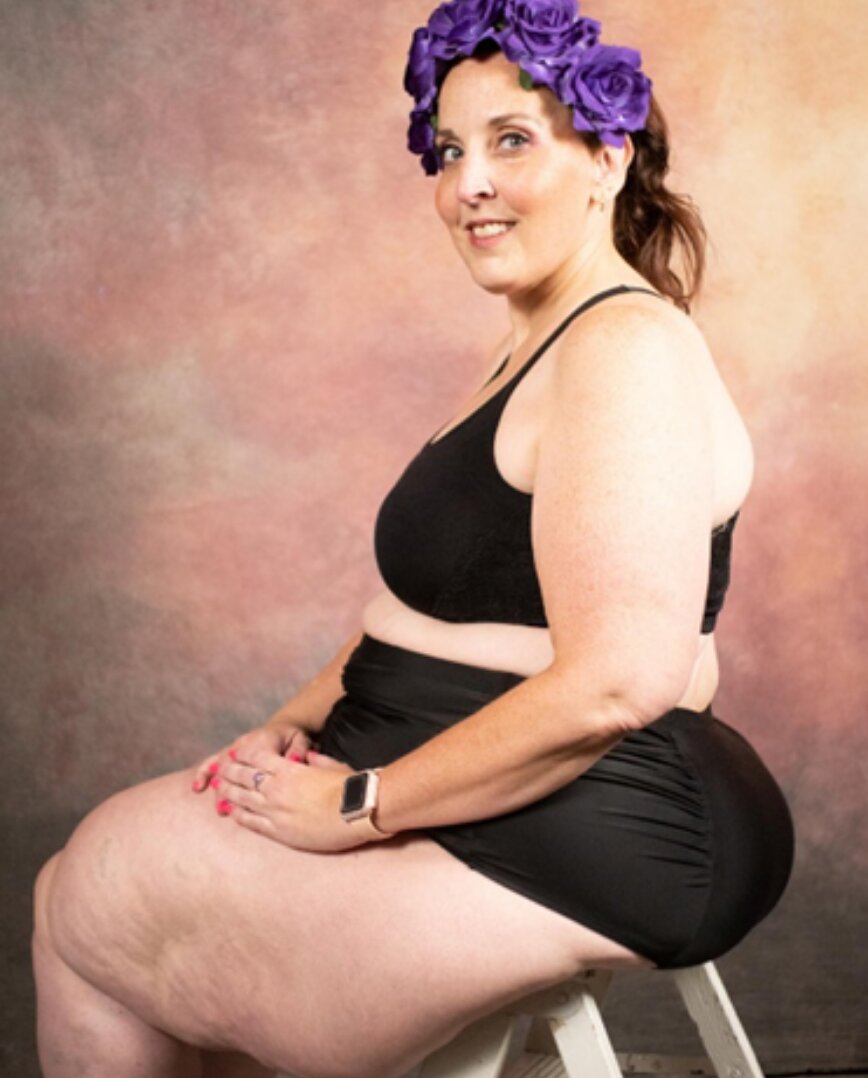 LIPEDEMA NEWS1